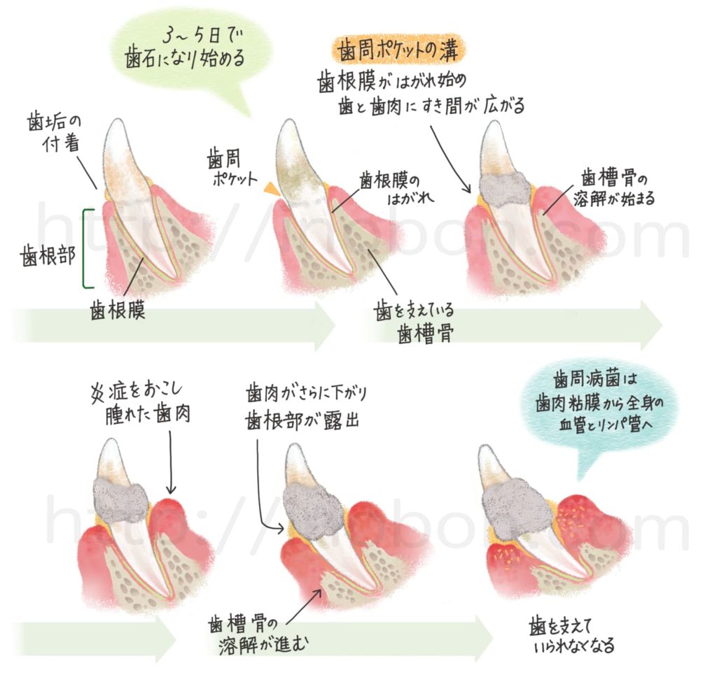 犬の歯の歯周病進行過程を描いた図解イラスト