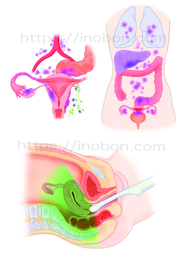 卵巣腫瘍の病変と転移、超音波検査