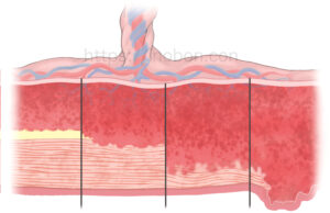 胎盤の癒着の進行を表した図