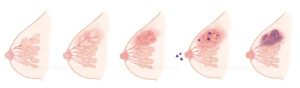 炎症をおこして腫れた乳腺