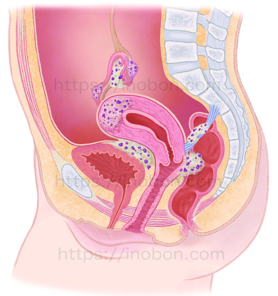 悪性腫瘍に侵された子宮や卵巣の解剖学イラスト