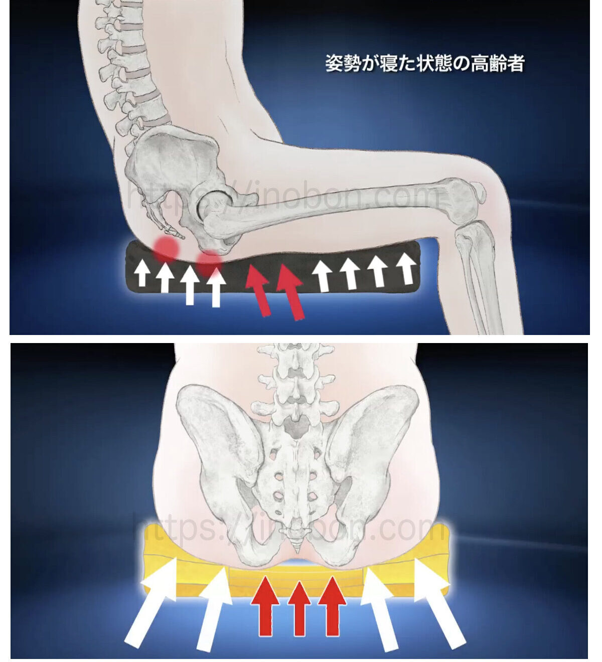 尾骨と坐骨結節部の骨、座位の人体イラストと褥瘡予防クッション