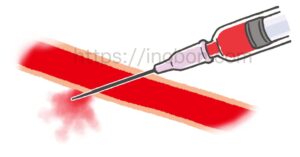 血液が入った注射器と針が刺さった血管