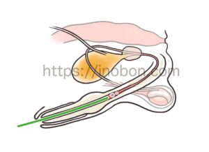 雄犬の泌尿器、尿道結石、閉塞