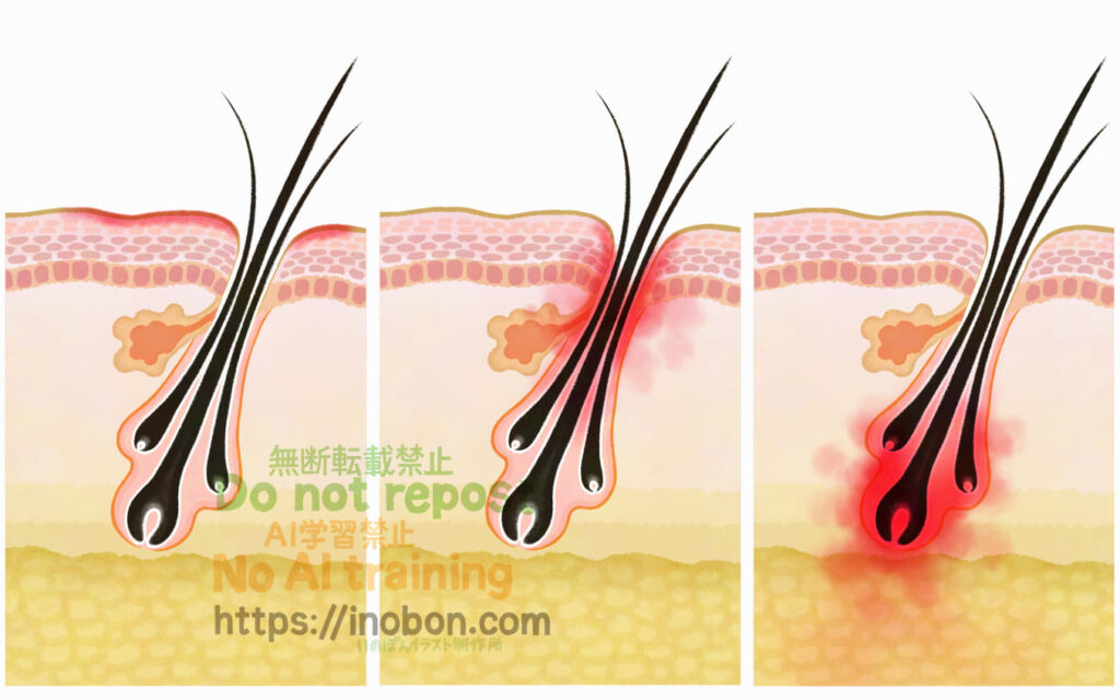 犬の膿皮症の分類を表した皮膚構造のイラスト