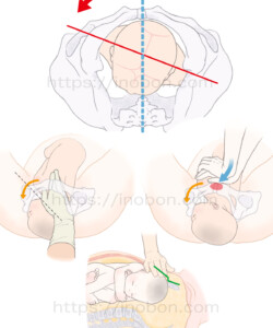 骨盤出口の前後径、肩甲難産の介助方法