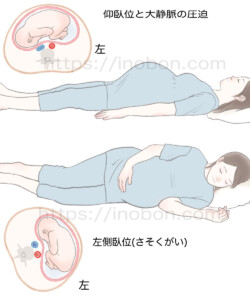 横になって眠る妊婦、妊娠中の大静脈の圧迫