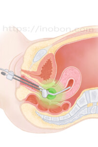 子宮頸がんに放射線療法を行う図