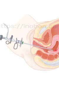 膣と子宮内の構造断面図、解剖学イラスト