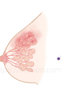 炎症をおこして腫れた乳腺