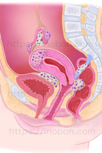 悪性腫瘍に侵された子宮や卵巣の解剖学イラスト
