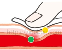 採血後の止血、圧迫止血をするポイント