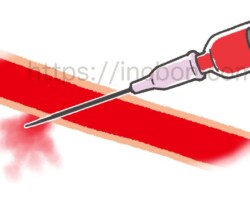 血液が入った注射器と針が刺さった血管
