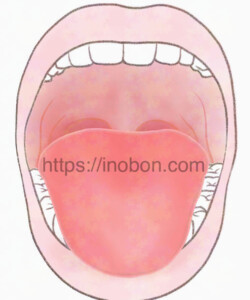 メディカ出版 2024年 『呼吸を妨げる舌根沈下』 舌根沈下 舌の根本が気管の入り口を塞いでいる