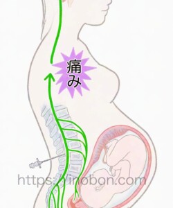 メディカ出版 オンラインセミナー 2024年【看護師・助産師のための無痛分娩】 硬膜外麻酔、痛みが脳に伝わる図