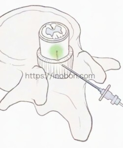 メディカ出版 オンラインセミナー 2024年【看護師・助産師のための無痛分娩】 硬膜外麻酔