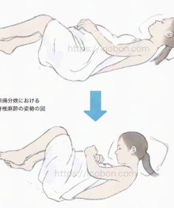 ラフ画の例 『硬膜外麻酔の体位の図』2024年 無痛分娩 姿勢