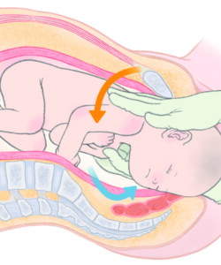 難産の介助、手技